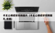 手足口病症状初期图片（手足口病症状初期图片 早期）