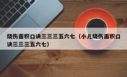 烧伤面积口诀三三三五六七（小儿烧伤面积口诀三三三五六七）