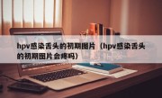 hpv感染舌头的初期图片（hpv感染舌头的初期图片会疼吗）