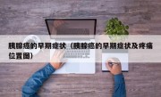 胰腺癌的早期症状（胰腺癌的早期症状及疼痛位置图）