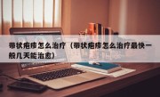 带状疱疹怎么治疗（带状疱疹怎么治疗最快一般几天能治愈）